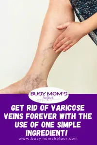 Get rid of Varicose veins